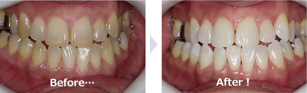 歯のホワイトニング（歯を白くする）を根岸海岸の歯科医院で受けられる 