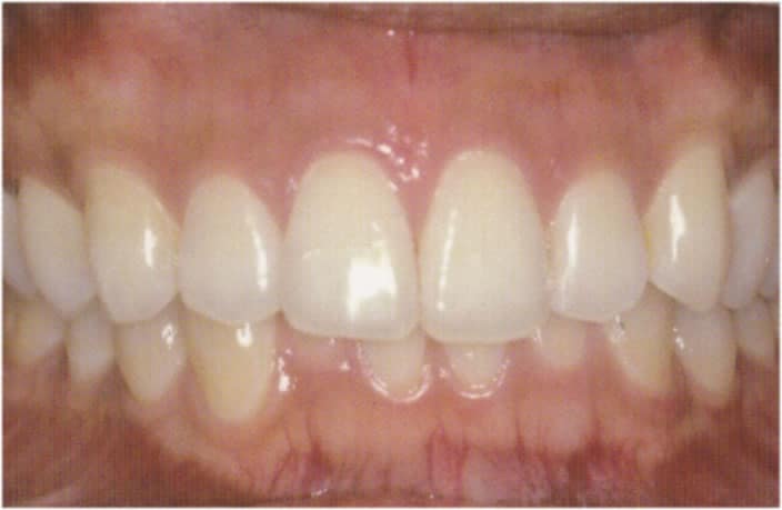 歯肉のホワイトニング治療後